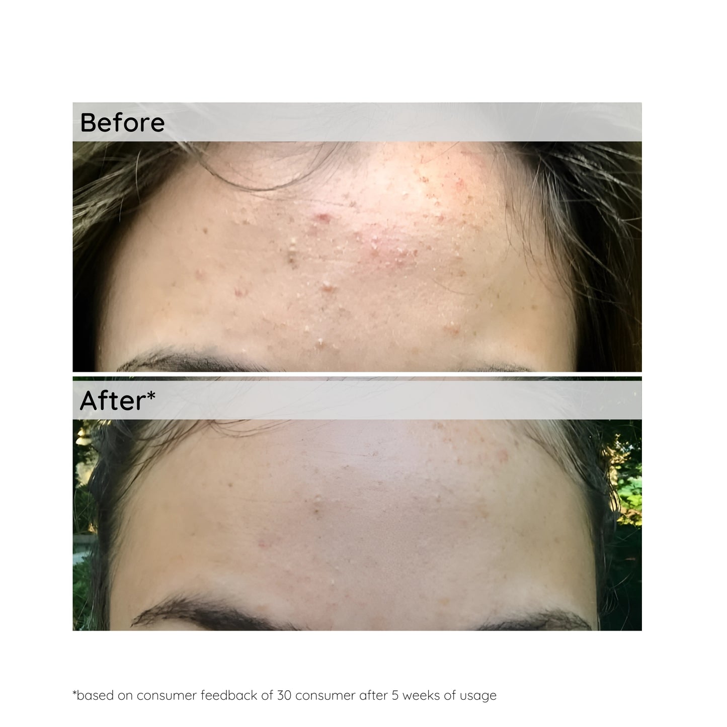 Anti-Acne & Oil Control Face Serum | 30ml