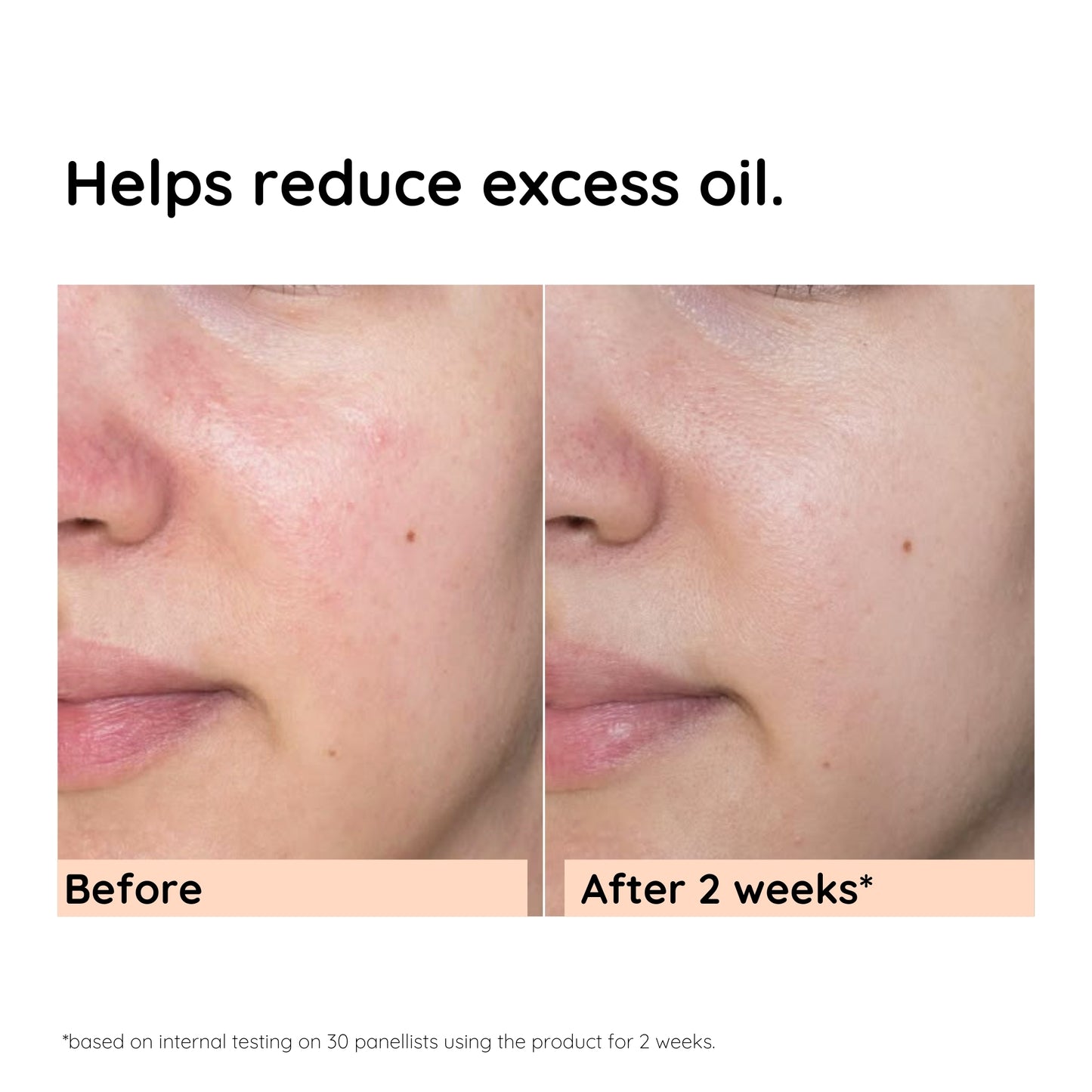 Anti-Acne & Oil Control Face Serum | 30ml