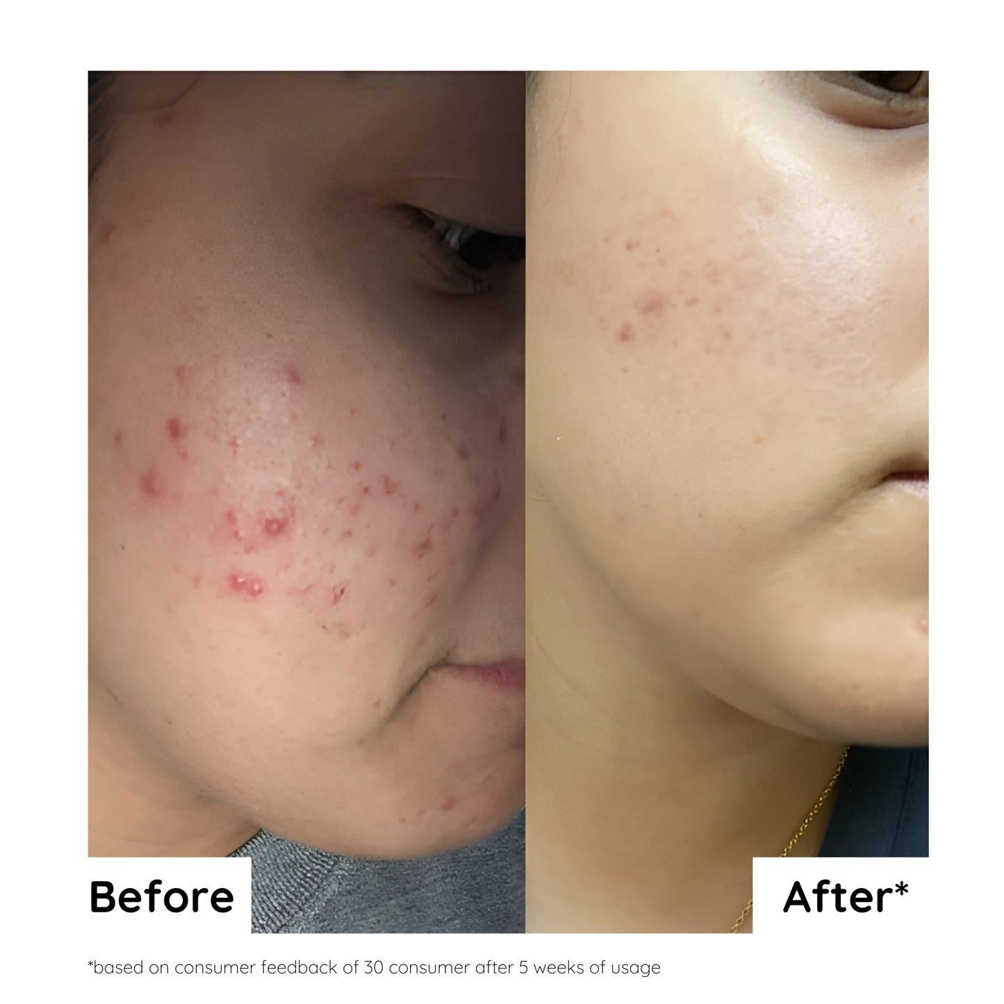 Anti-Acne & Oil Control Face Serum | 30ml