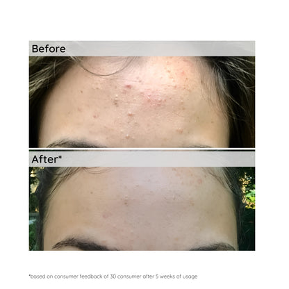 Anti-Acne & Oil Control Face Serum | 30ml