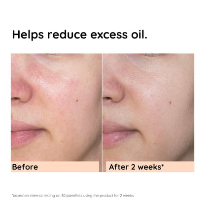 Anti-Acne & Oil Control Face Serum | 30ml