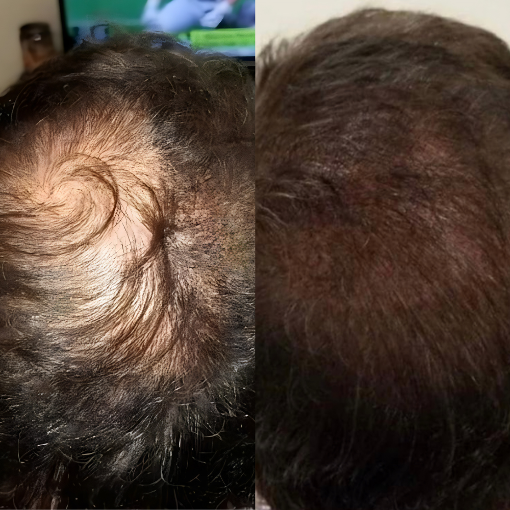 97% saw less hair fall and dandruff