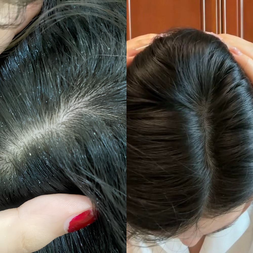 felt less scalp itching & flakes.