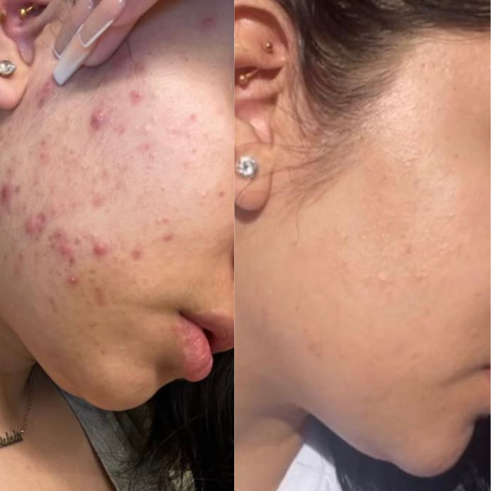 saw fewer acne breakouts in 14d